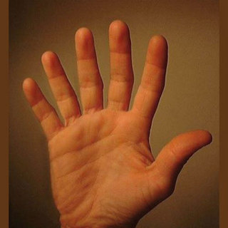 Hand mit 6 Fingern
