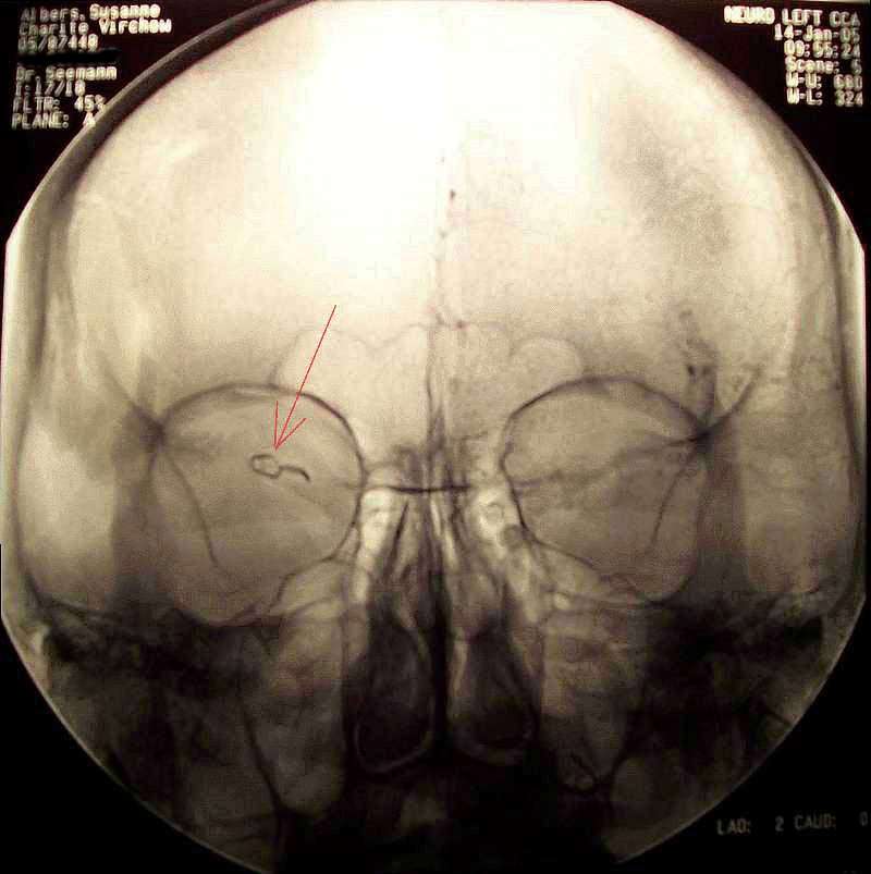 Titanclip FT722 von Yasargil für das Media Aneurysma rechts